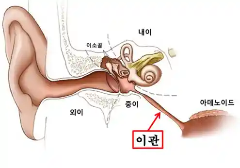 이관개방증이란 무엇